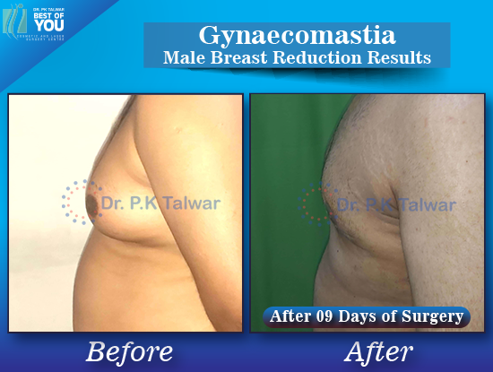 Gynaecomastia before after image